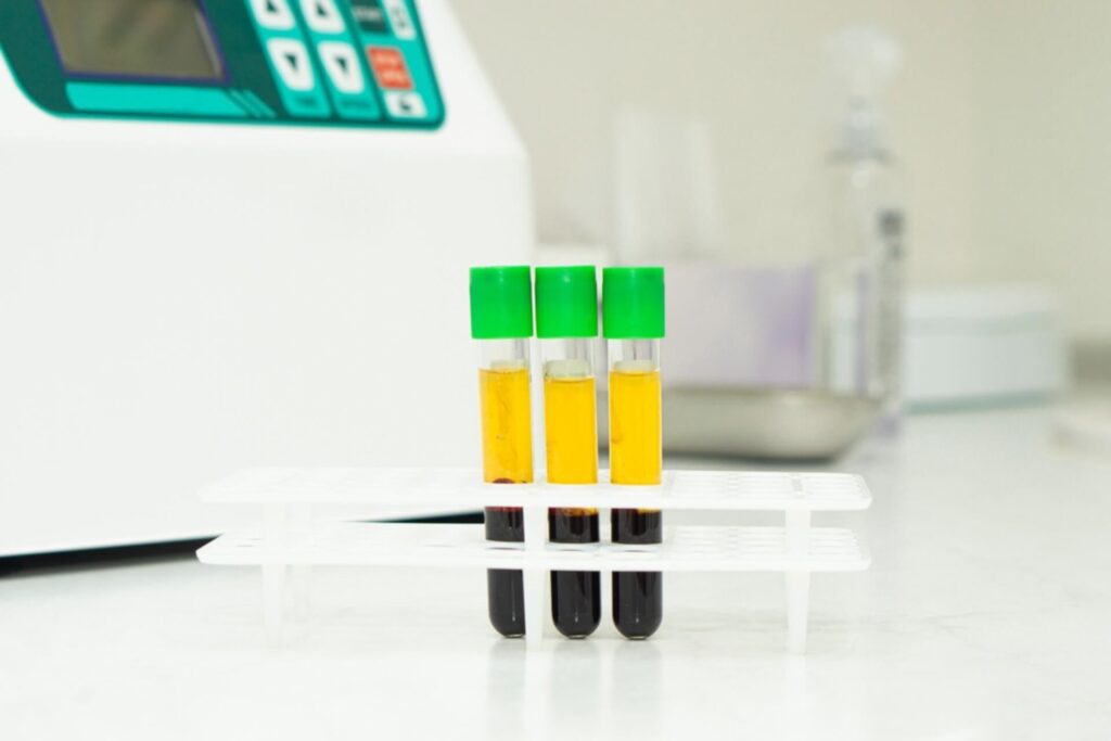 Three medical test tubes with blood plasma stand on the medical table