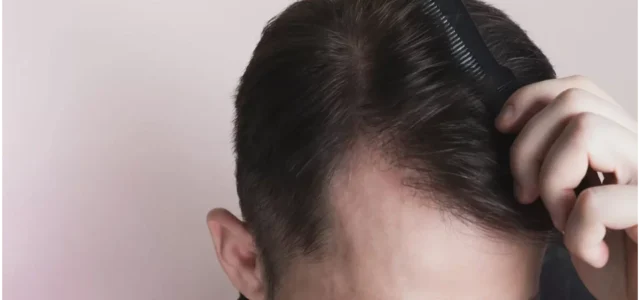 exosomes for hair loss