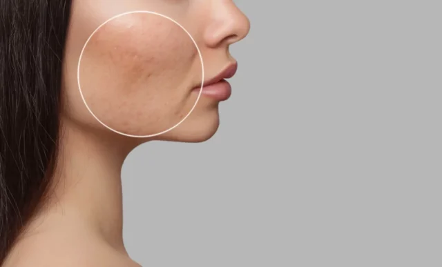 Photo before and after treatment for acne